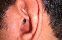 Invisible Hearing Aid in the ear